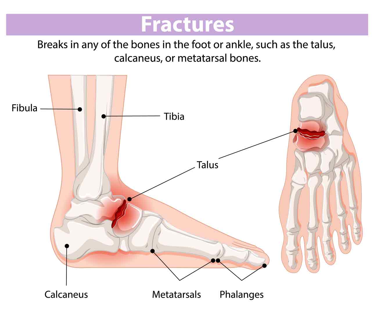 Ankle-Fracture-SportsOrtho