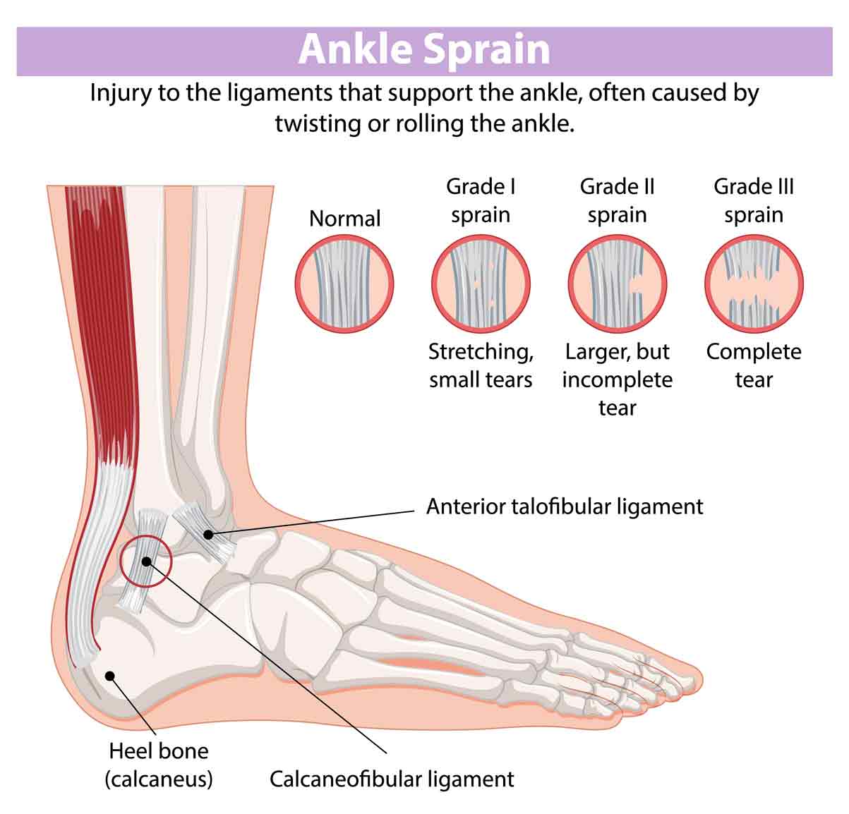 Ankle-Sprain-SportsOrtho