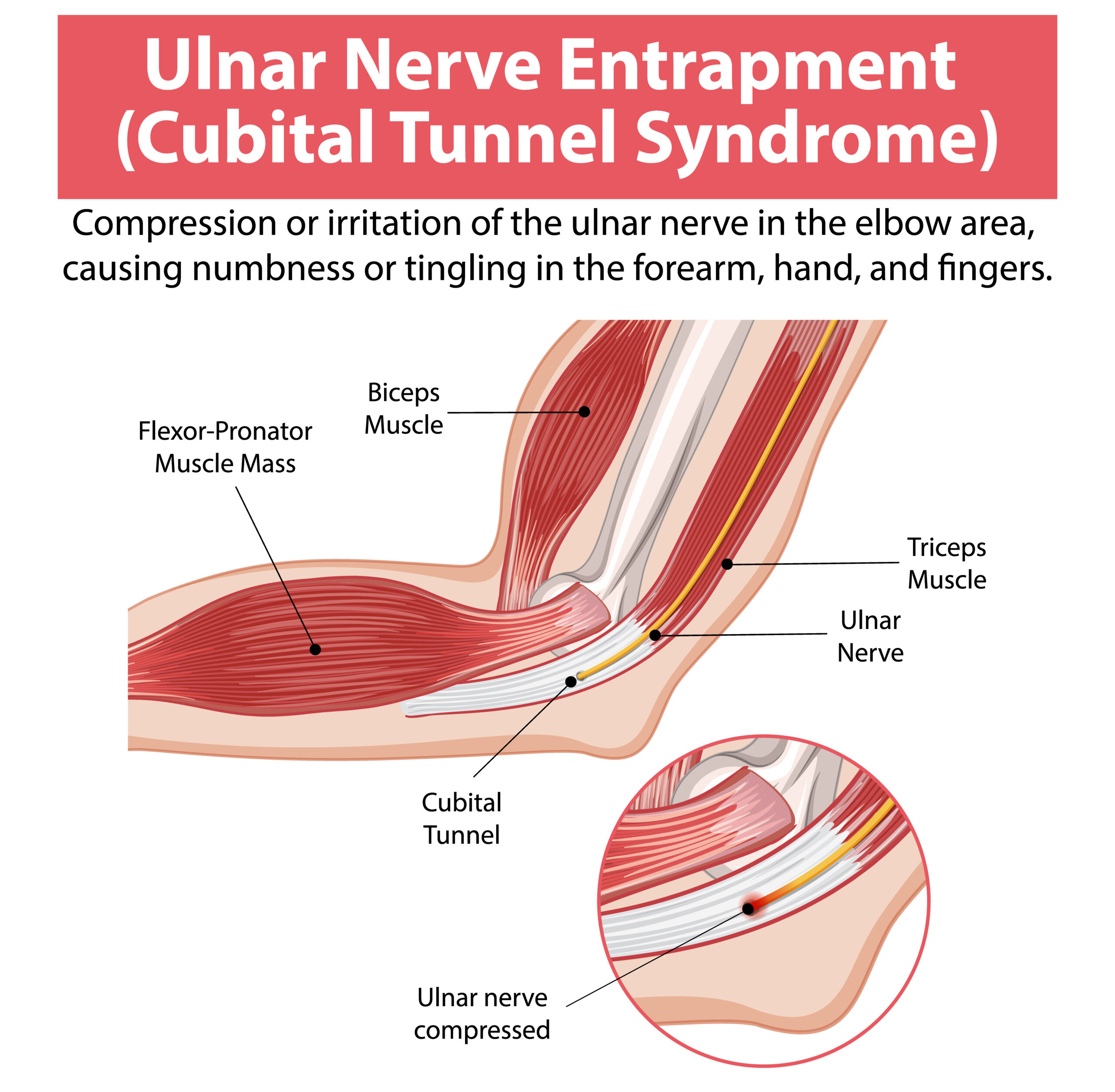 Cubital Tunnel Syndrome