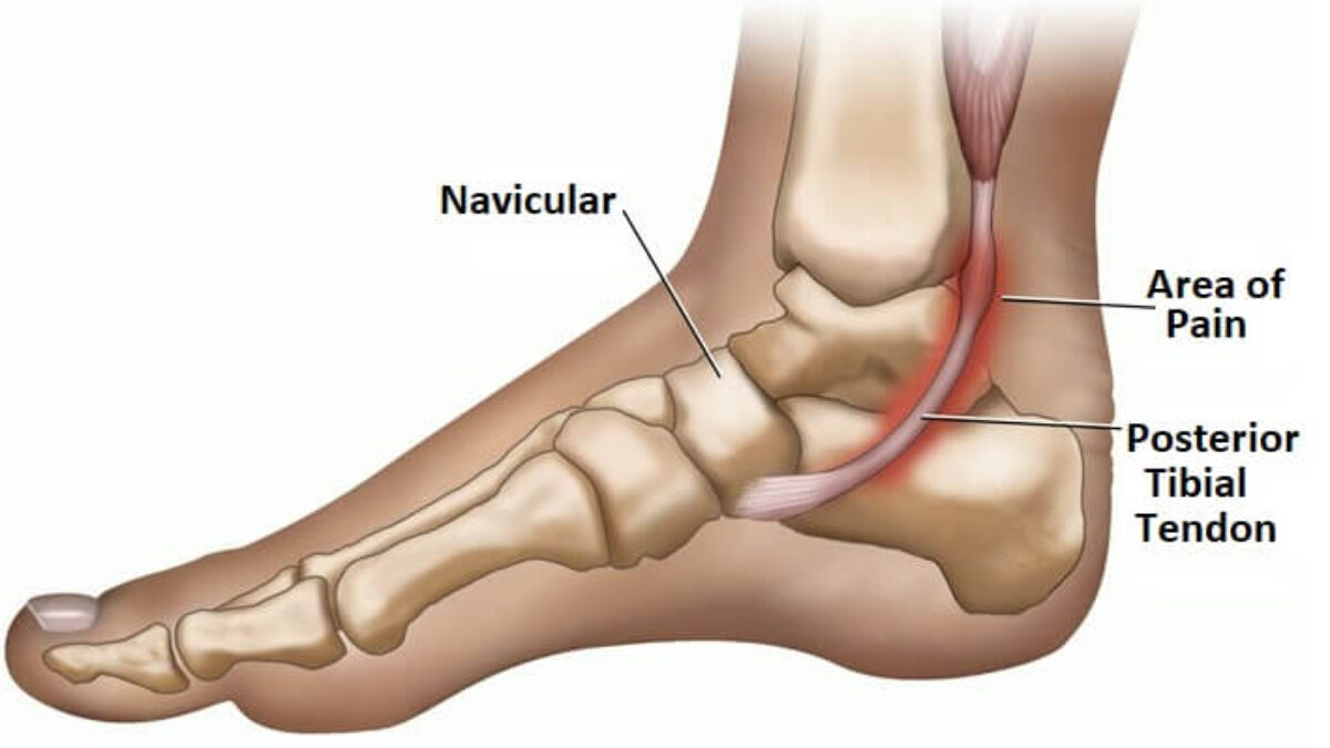 Posterior-Tibial-Tendon-Dysfunction-PTTD-1200x675