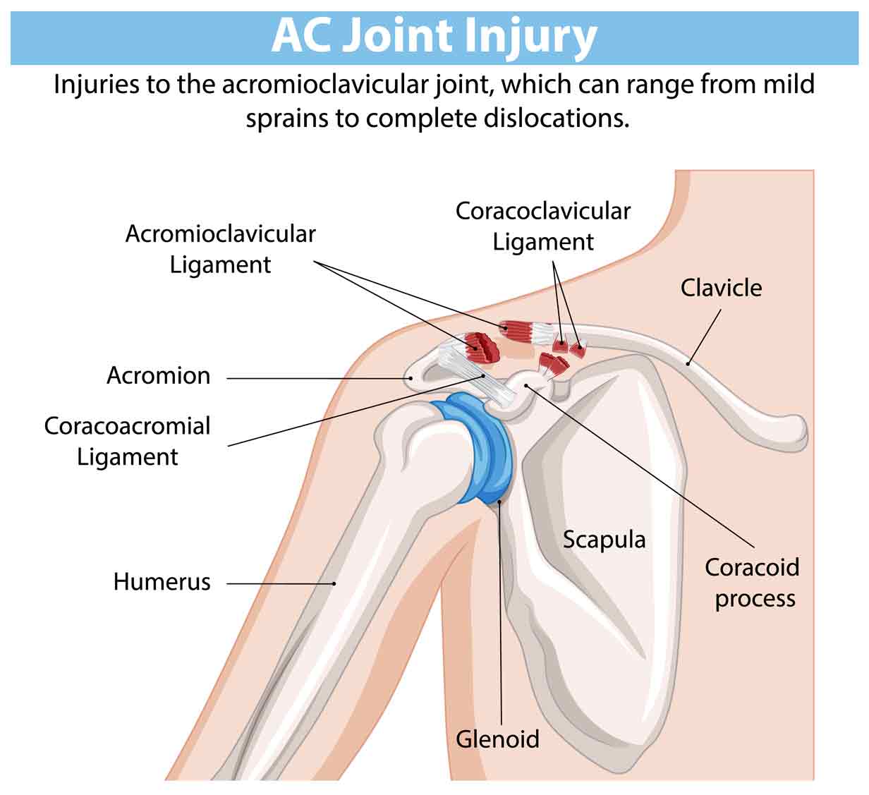 Shoulder-Separation-(AC-Joint-Separation)-SportsOrtho