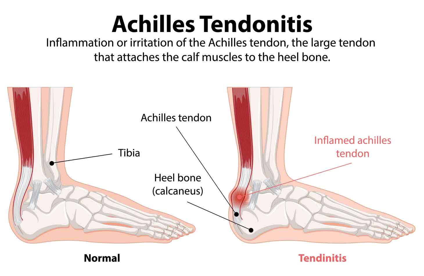 achilles-tendonitis-SportsOrtho