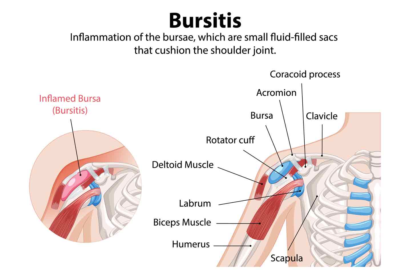 bursitis-shoulder-joint-SportsOrtho