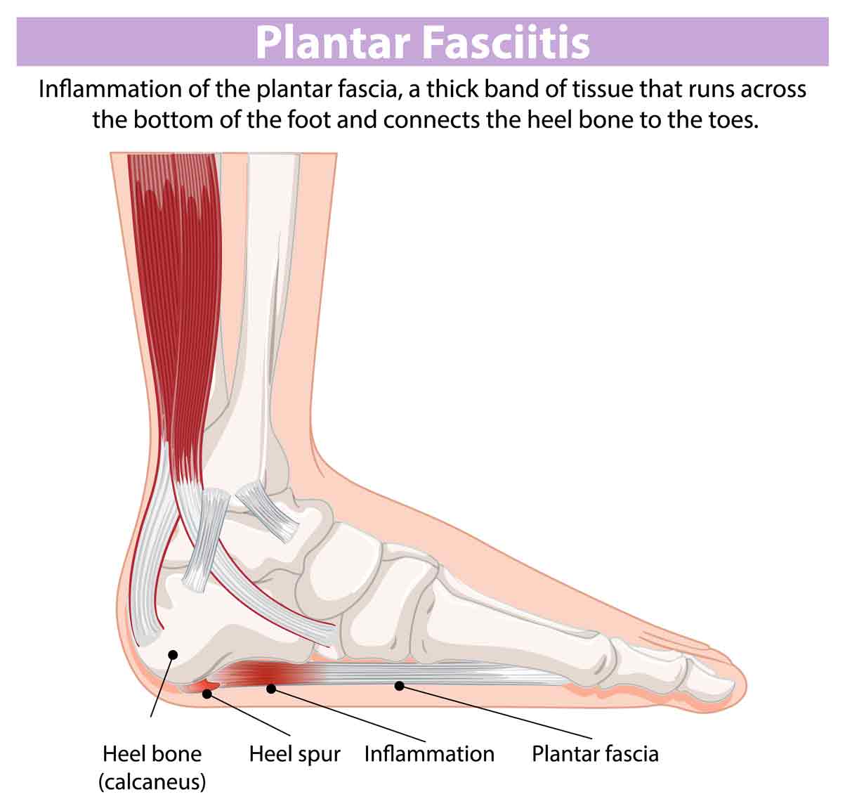 plantar-fasciitis-SportsOrtho